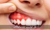 خونریزی لثه را چه زمانی باید جدی گرفت؟ | علت‌ها، نشانه‌های خطر و درمان
